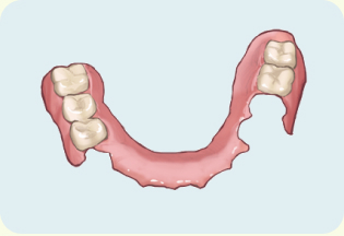 ノンクラスプデンチャー